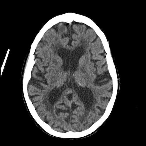 снимок КТ головного мозга